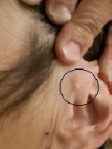 Implant on left side with circle to indicate location